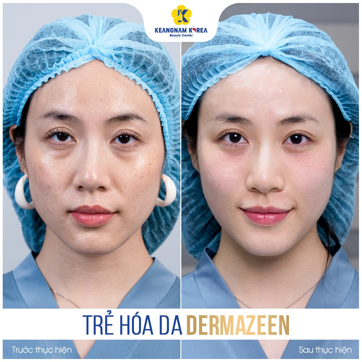 Trang chủ 56 BF-AF_Dermazeen2