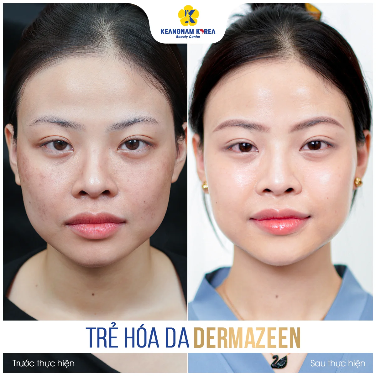 Trang chủ 58 BF-AF_Dermazeen3