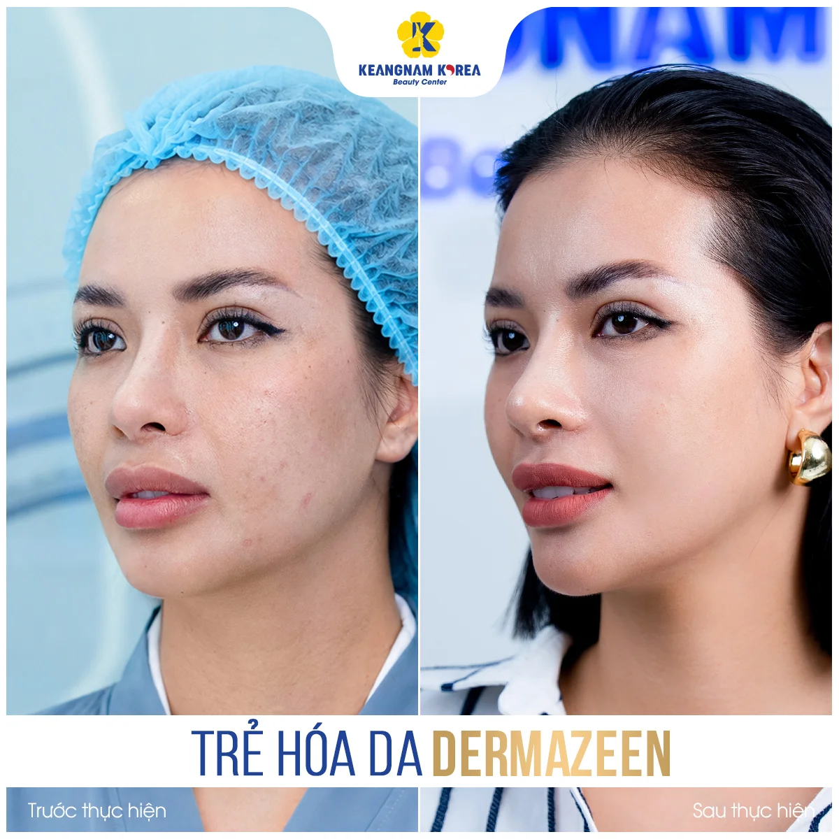 Trang chủ 53 BF-AF_Dermazeen4