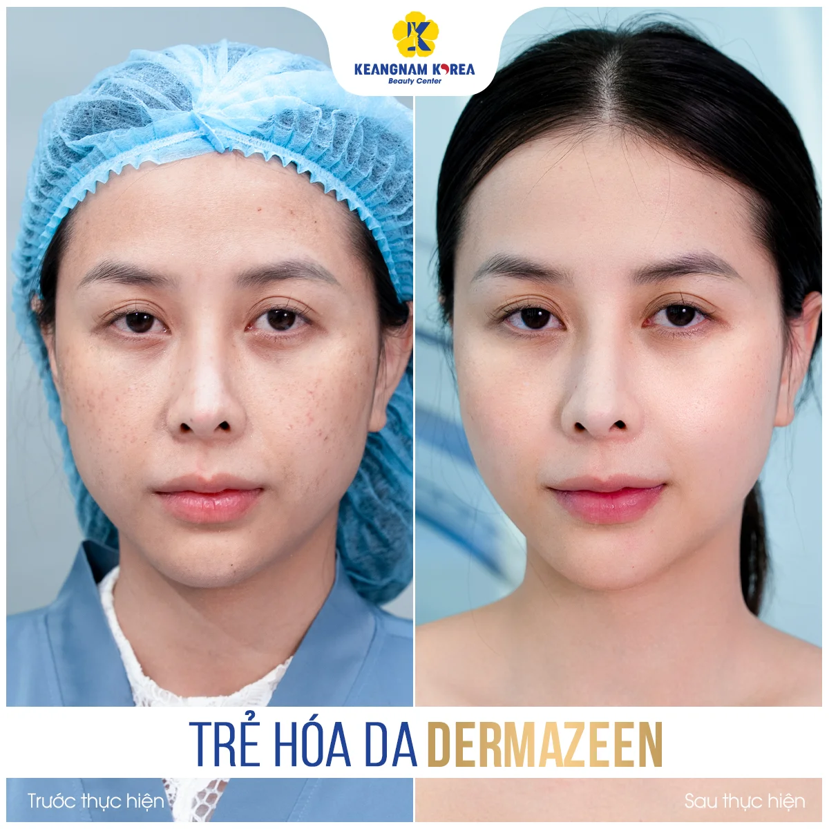 Trang chủ 60 BF-AF_Dermazeen5
