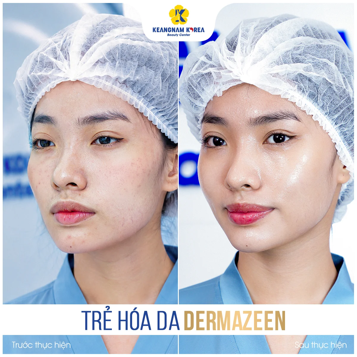 Trang chủ 57 BF-AF_Dermazeen6