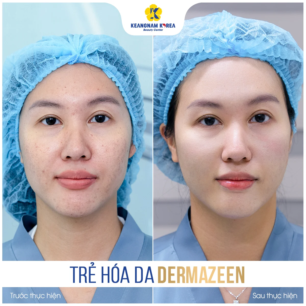 Trang chủ 52 BF-AF_Dermazeen7