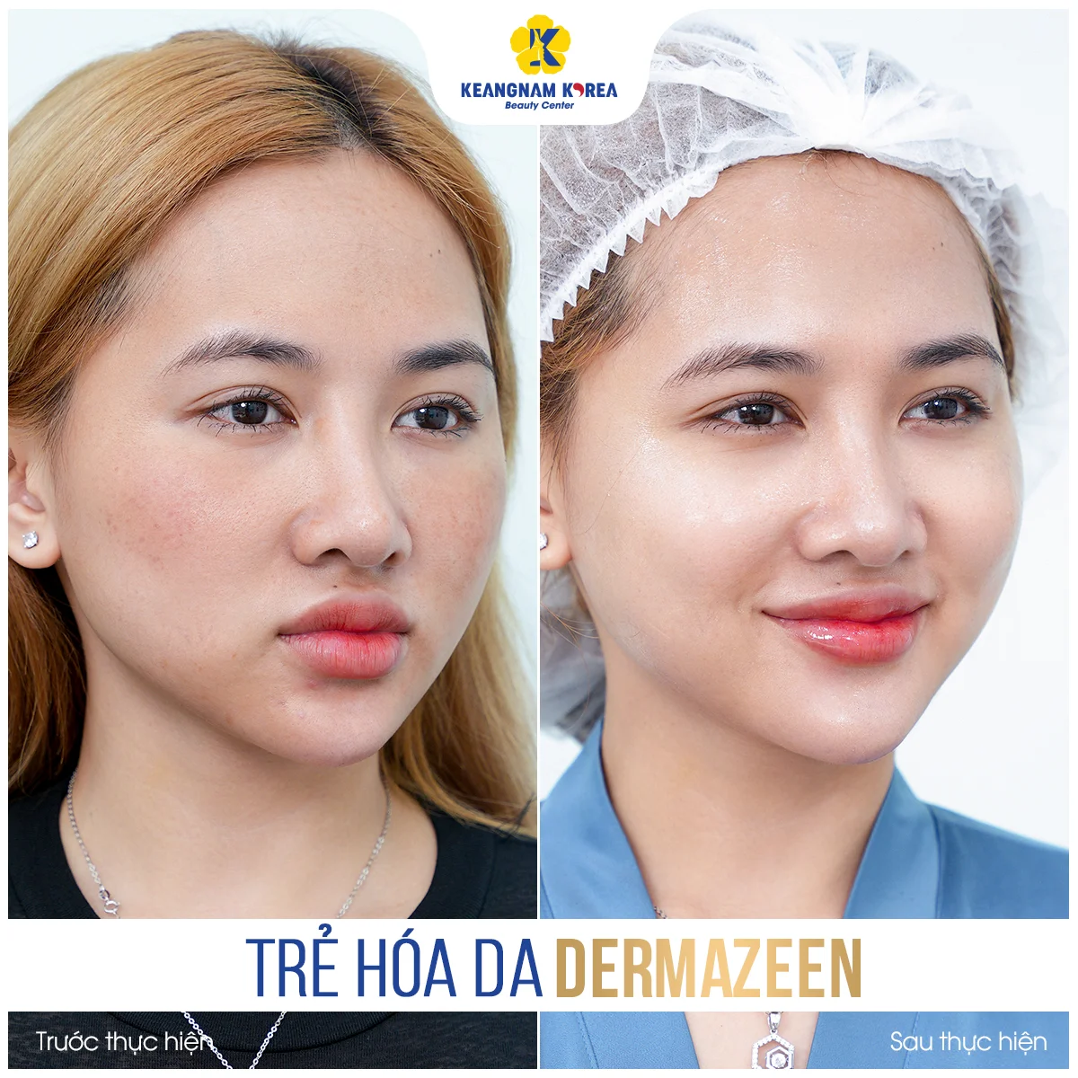 Trang chủ 54 BF-AF_Dermazeen8