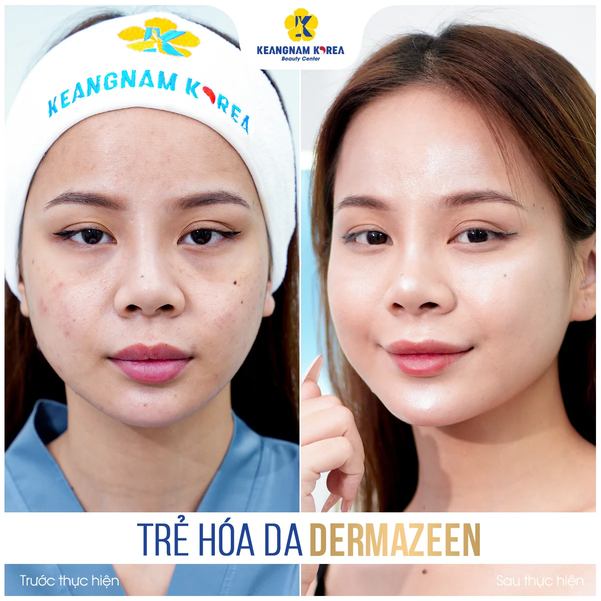 Trang chủ 59 BF-AF_Dermazeen9