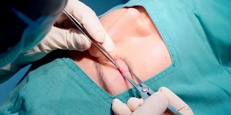 Cắt mí mắt giá bao nhiêu? Bảng giá đầy đủ 7 phương pháp cắt mí cùng các công nghệ mới nhất TP Hồ Chí Minh 2026 4 cắt mí mắt giá bao nhiêu