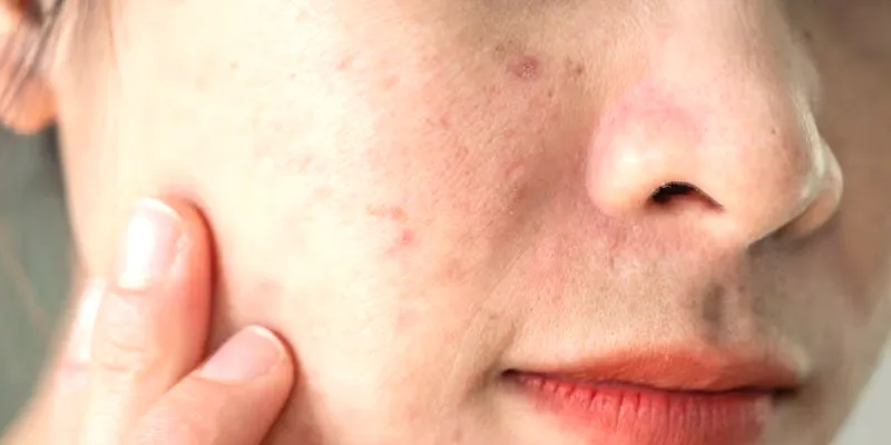 7 dấu hiệu lão hóa da phổ biến: Cách nhận biết và khắc phục sớm 4 Da lao hoa bi mong