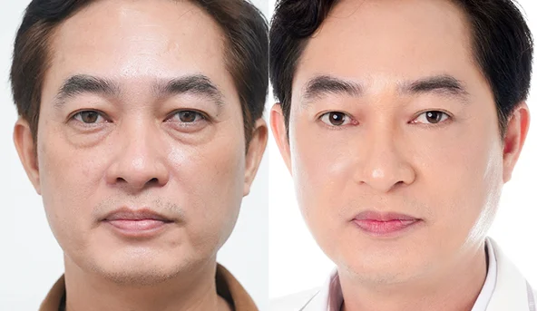 Lấy mỡ mắt