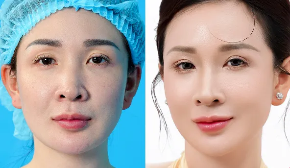 Cấy mỡ mắt