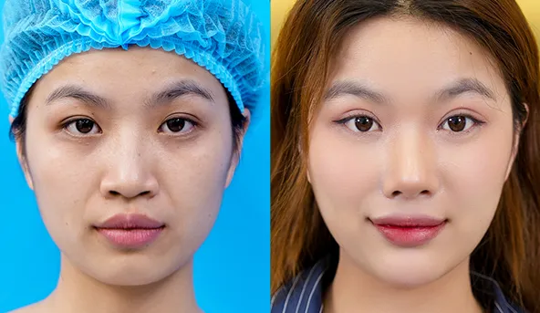 Tạo hình 2 mí