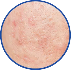 Điều trị nám DERMAZEEN 21 Cải thiện vấn đề sẹo của da
