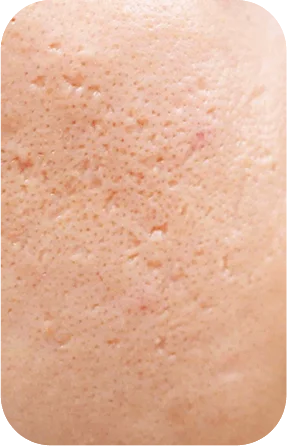 Điều trị nám DERMAZEEN 12 Da có vấn đề sẹo rỗ sẹo lõm