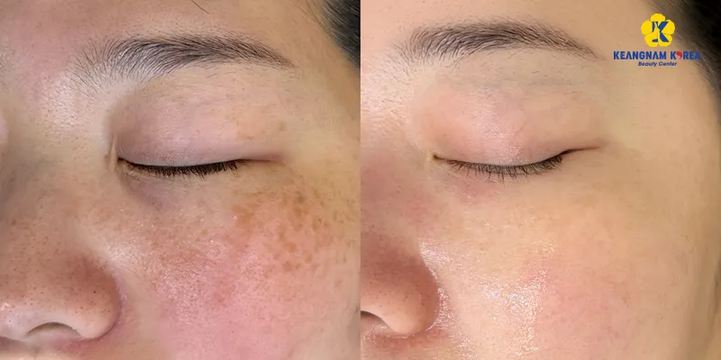 Tiêm meso trị nám có hiệu quả không? Bao lâu thì hết? Tác dụng phụ là gì? 3 Tiêm meso trị nám