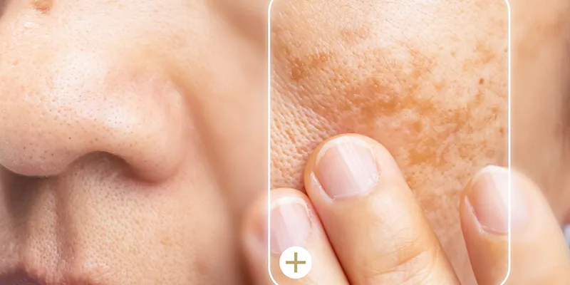 Tiêm meso trị nám có hiệu quả không? Bao lâu thì hết? Tác dụng phụ là gì? 1 Tiêm meso trị nám