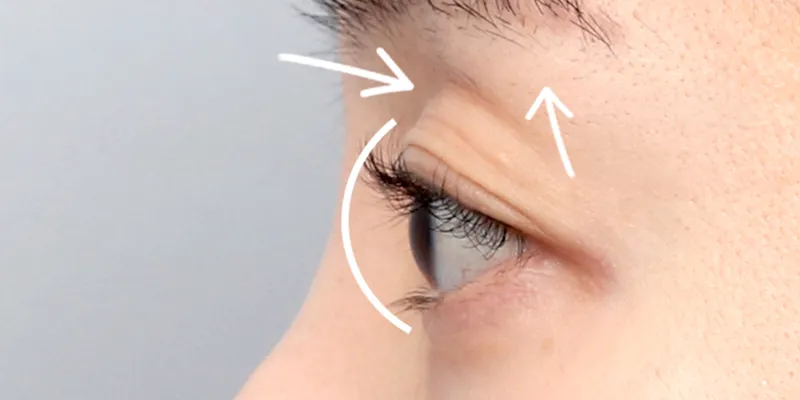 Có nên cấy mỡ hốc mắt không? 3 Có nên cấy mỡ hốc mắt không?
