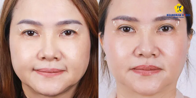 Bao nhiêu tuổi thì nâng cung mày là lựa chọn tốt nhất? 2 Bao nhiêu tuổi thì nâng cung mày là lựa chọn tốt nhất?