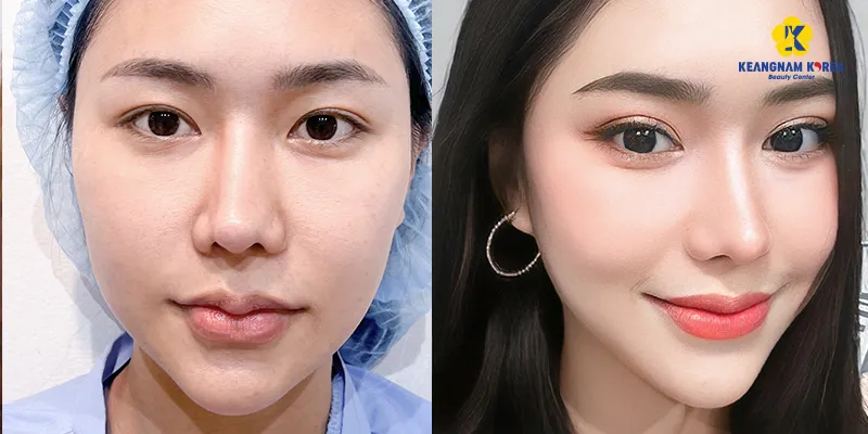 Bao nhiêu tuổi thì nâng cung mày là lựa chọn tốt nhất? 3 Bao nhiêu tuổi thì nâng cung mày là lựa chọn tốt nhất?