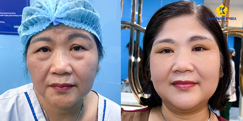 Có nên nâng cung chân mày không? Những điều cần biết trước khi quyết định 3 Có nên nâng cung chân mày không