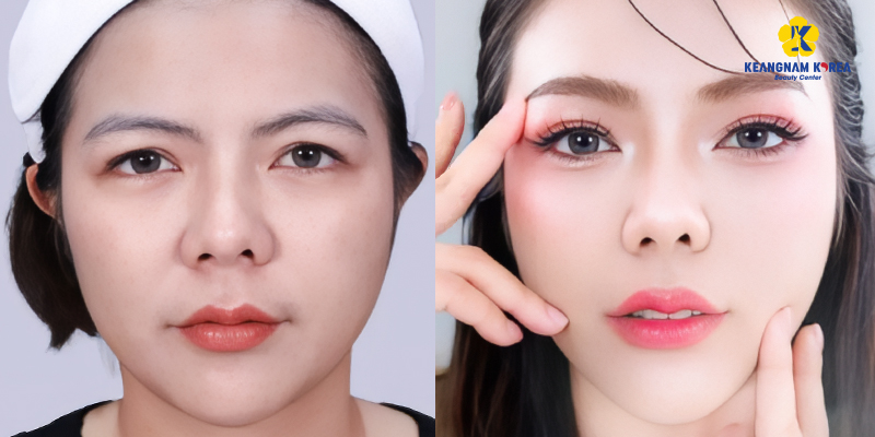 Nâng cung mày ở đâu đẹp? Top 5 địa chỉ uy tín, an toàn tại TP Hồ Chí Minh 3 Nâng cung mày ở đâu đẹp