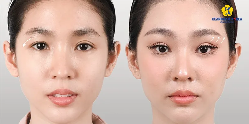 Brow Lift Cost in Vietnam 2 Brow Lift Cost in Vietnam