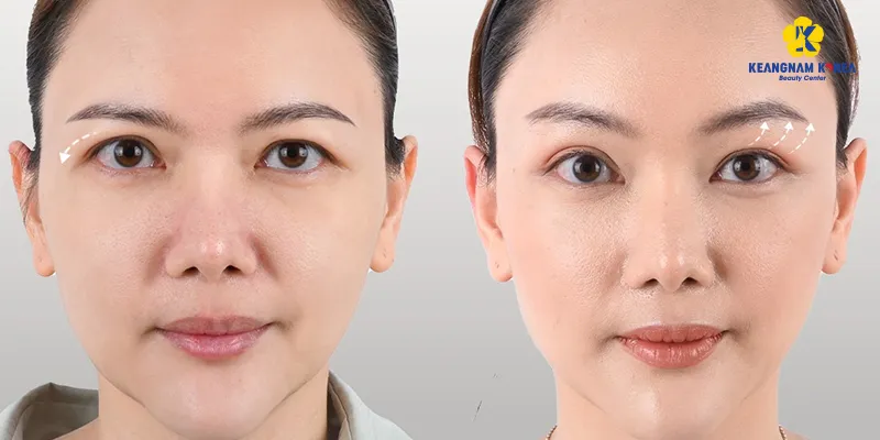 Brow Lift Cost in Vietnam 4 brow lift cost vietnam 3