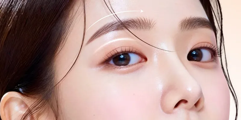 Brow Lift Cost in Vietnam 1 Brow Lift Cost in Vietnam