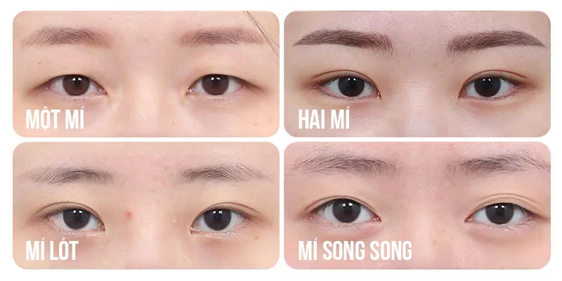 Các dạng mí mắt đẹp và thịnh hành 2026 2 các dạng mí mắt