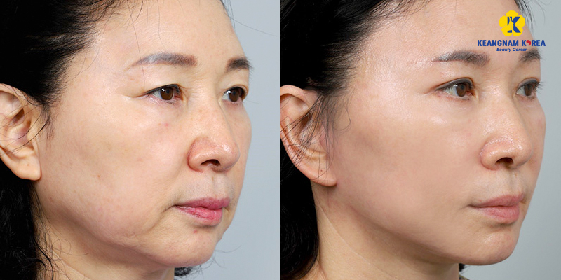 Căng da mặt SMAS là gì? Giá bao nhiêu? Ở đâu tốt? 3 căng da mặt smas là gì