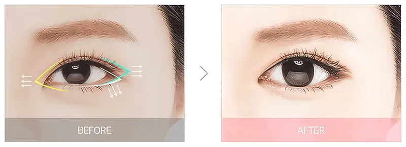 Canthopexy vs Canthoplasty: Key Differences 3 Canthopexy vs Canthoplasty