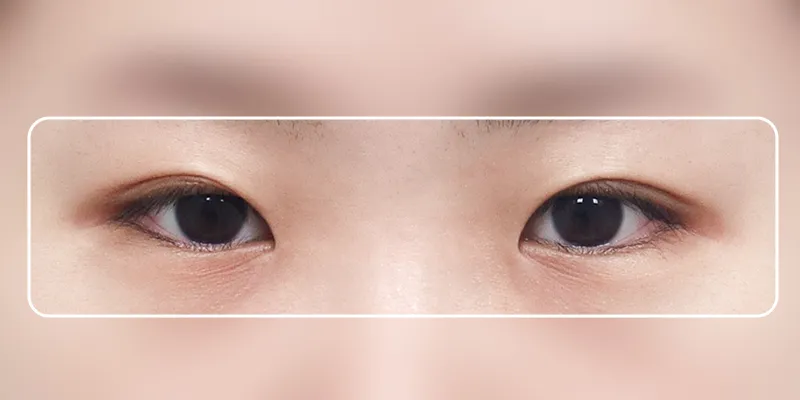 Canthopexy vs Canthoplasty: Key Differences 2 Canthopexy vs Canthoplasty