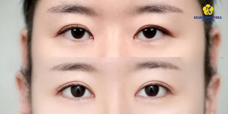 Canthopexy vs Canthoplasty: Key Differences 5 Canthopexy vs Canthoplasty