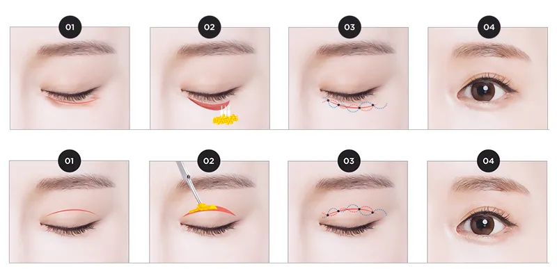 Cắt mí mắt giá bao nhiêu? Bảng giá đầy đủ 7 phương pháp cắt mí cùng các công nghệ mới nhất TP Hồ Chí Minh 2026 2 cắt mí mắt giá bao nhiêu