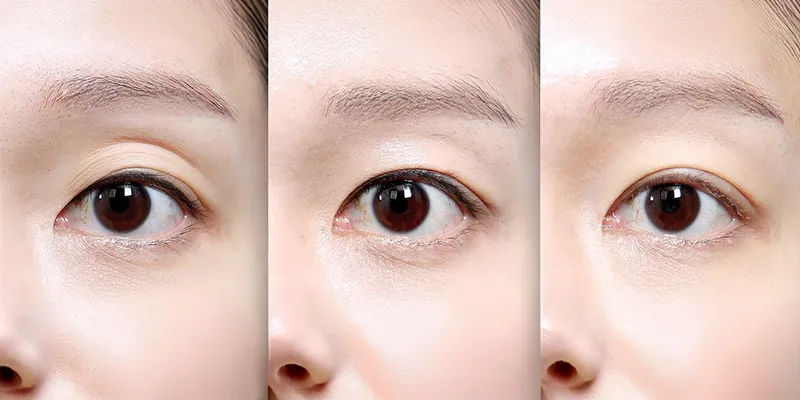 Có nên cấy mỡ hốc mắt không? 4 Có nên cấy mỡ hốc mắt không?
