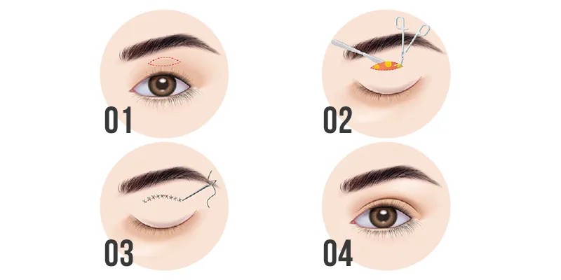 Có nên tiêm đầy hốc mắt bằng filler không? 4 Có nên tiêm đầy hốc mắt bằng filler không?
