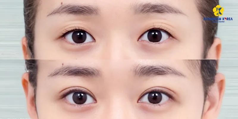 Có nên cấy mỡ hốc mắt không? 2 Có nên cấy mỡ hốc mắt không?