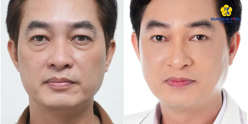 Các phương pháp phẫu thuật thẩm mỹ mắt 2 lay mo Bong mat duoi