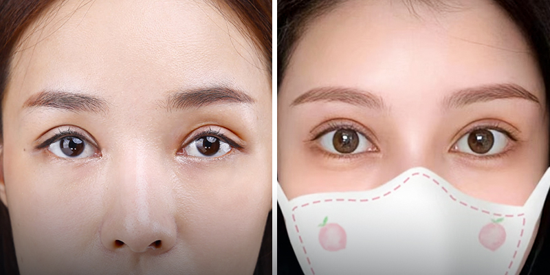 Medial Epicanthoplasty: What Is the Chinese Teardrop Eye Trend and Who Suits It? 4 Medial Epicanthoplasty cost