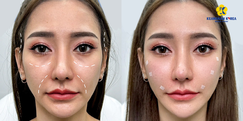 Mesotherapy Under Eye Circles: Does It Really Work in 2026? 2 mesotherapy for under eye circles