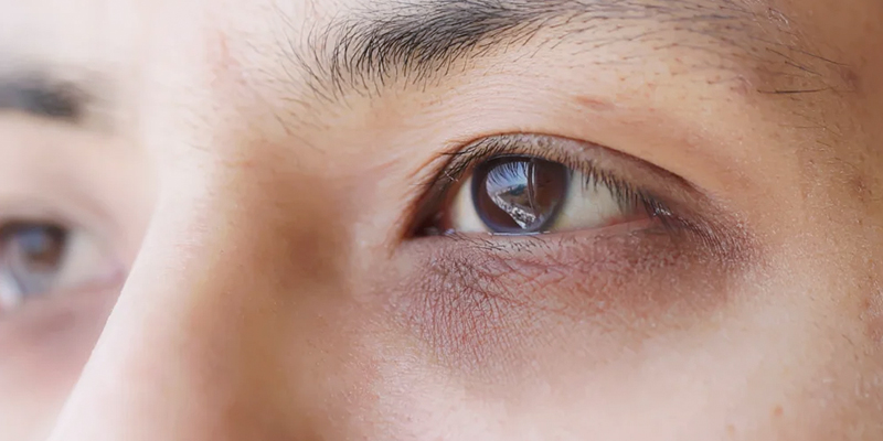 Mesotherapy Under Eye Circles: Does It Really Work in 2026? 1 mesotherapy under eye circles