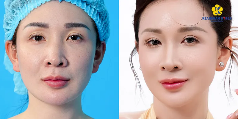 Mí sụp nên cắt mí hay nâng cung mày? Đâu là phương pháp phù hợp hơn với tình trạng của bạn? 3 Mí sụp nên cắt mí hay nâng cung mày