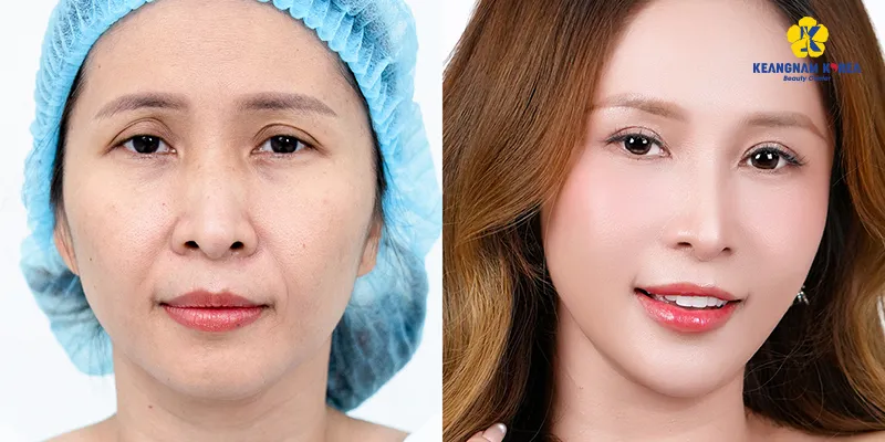 Mí sụp nên cắt mí hay nâng cung mày? Đâu là phương pháp phù hợp hơn với tình trạng của bạn? 4 Mí sụp nên cắt mí hay nâng cung mày