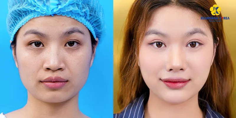 Các phương pháp phẫu thuật thẩm mỹ mắt 6 Mở Rộng Góc Mắt Phẫu Thuật Thẩm Mỹ Làm Mắt To