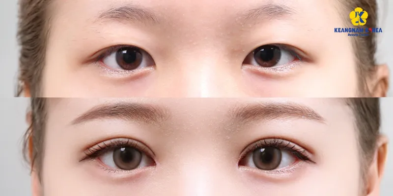 Phẫu thuật mở góc mắt là gì? Giá bao nhiêu? Phù hợp cho ai? Ở đâu tốt? 3 Phẫu thuật mở góc mắt