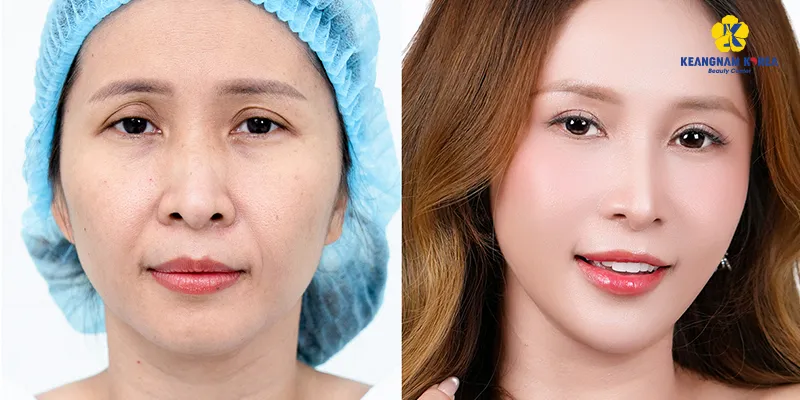 Các phương pháp phẫu thuật thẩm mỹ mắt 4 Phẫu Thuật Nâng Cung Mày Giấu Chỉ