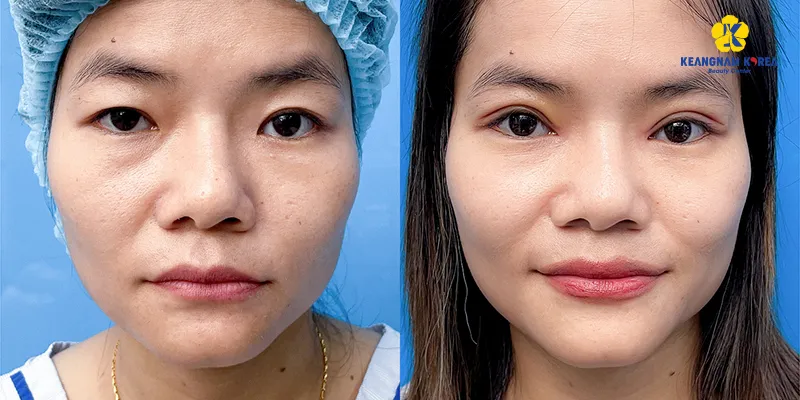 Các phương pháp phẫu thuật thẩm mỹ mắt 7 Phẫu Thuật Nâng Đuôi Mắt