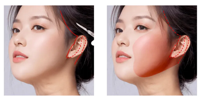 So sánh các công nghệ trẻ hóa da mặt tốt nhất hiện nay 4 công nghệ trẻ hóa da
