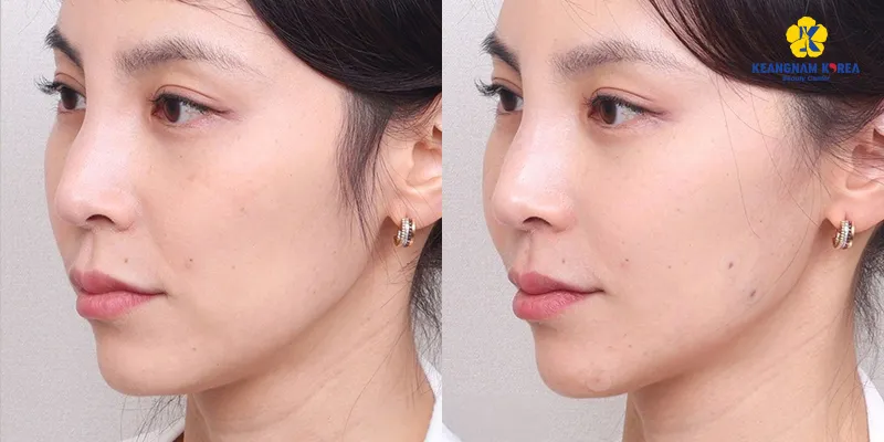So sánh các công nghệ trẻ hóa da mặt tốt nhất hiện nay 3 công nghệ trẻ hóa da