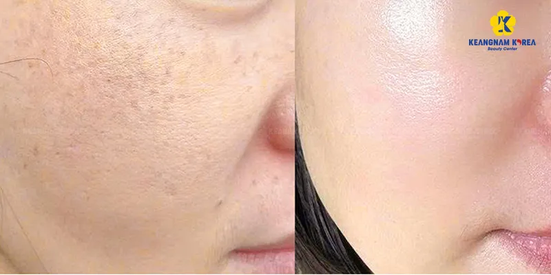 Tác dụng của cấy meso là gì? Có thể thực hiện ở những vùng nào? 3 Tác dụng của cấy meso là gì?