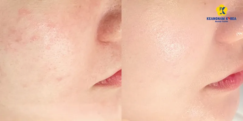 Tác dụng của cấy meso là gì? Có thể thực hiện ở những vùng nào? 5 Tác dụng của cấy meso là gì?