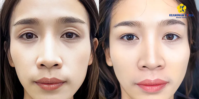 Có nên tiêm đầy hốc mắt bằng filler không? 2 Có nên tiêm đầy hốc mắt bằng filler không?