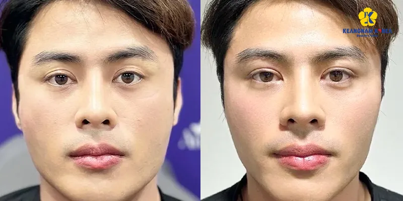 Có nên tiêm đầy hốc mắt bằng filler không? 3 Có nên tiêm đầy hốc mắt bằng filler không?